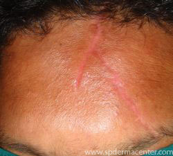 Acne Scar Co2 Fraxel-Before